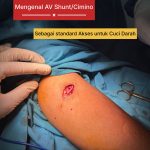 AV Shunt Cimino