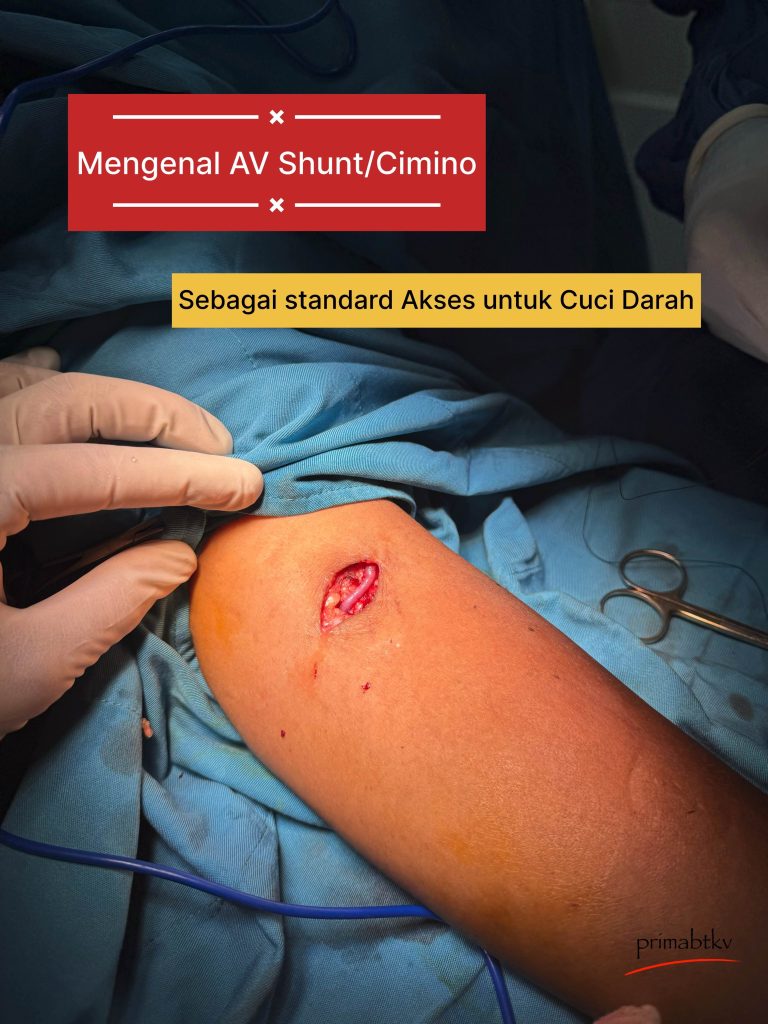 AV Shunt Cimino