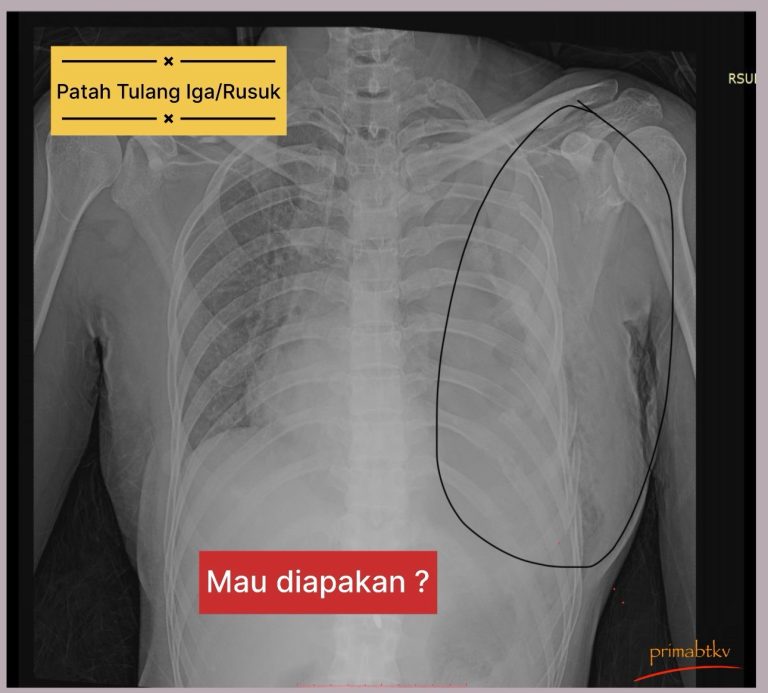 patah tulang rusuk