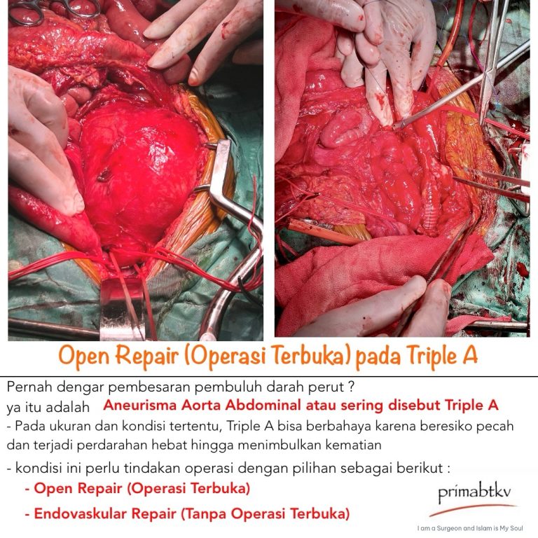 Open Repair (Operasi Terbuka) pada Triple A
