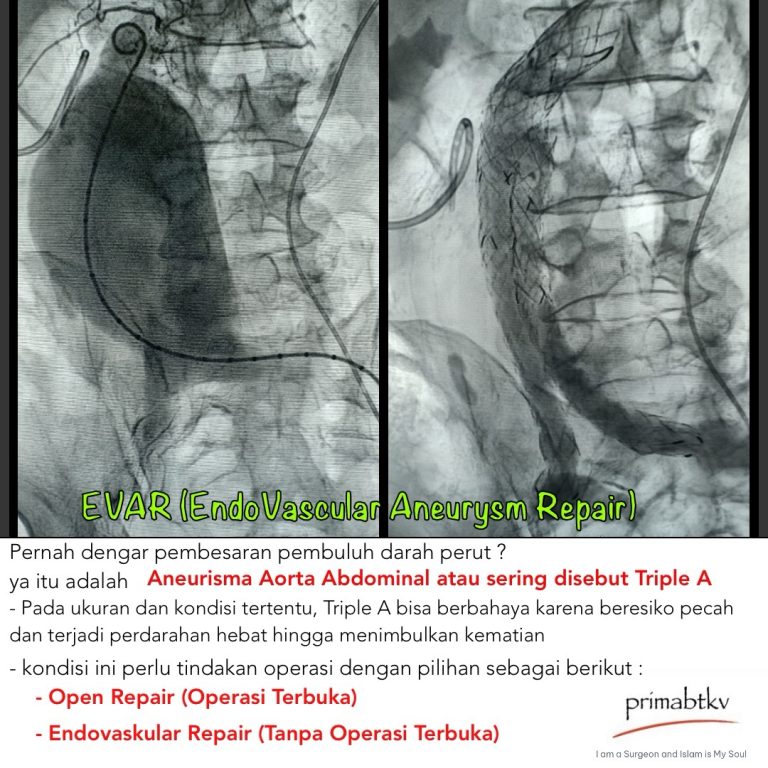 Endovaskular Repair Pada Triple A