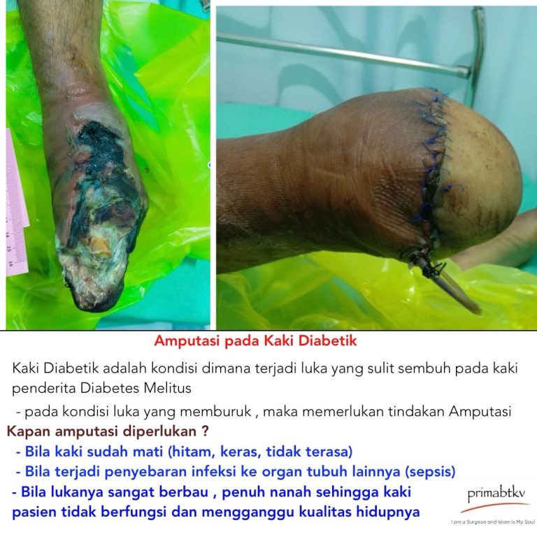 Amputasi pada Kaki Diabetik