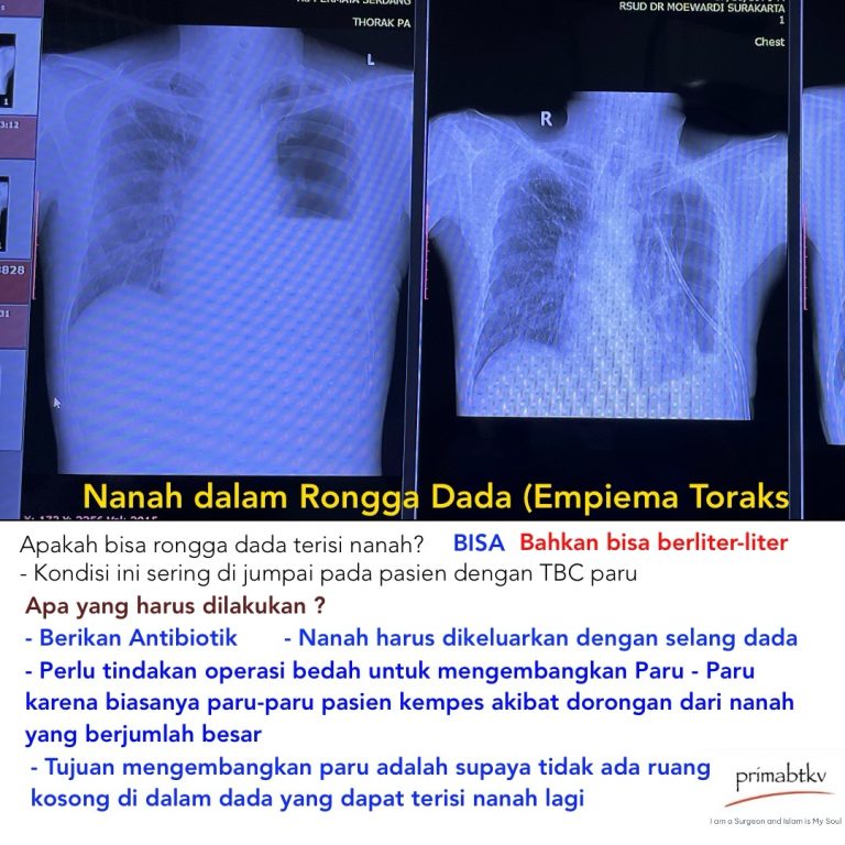 Nanah Dalam Rongga Dada (Empiema)