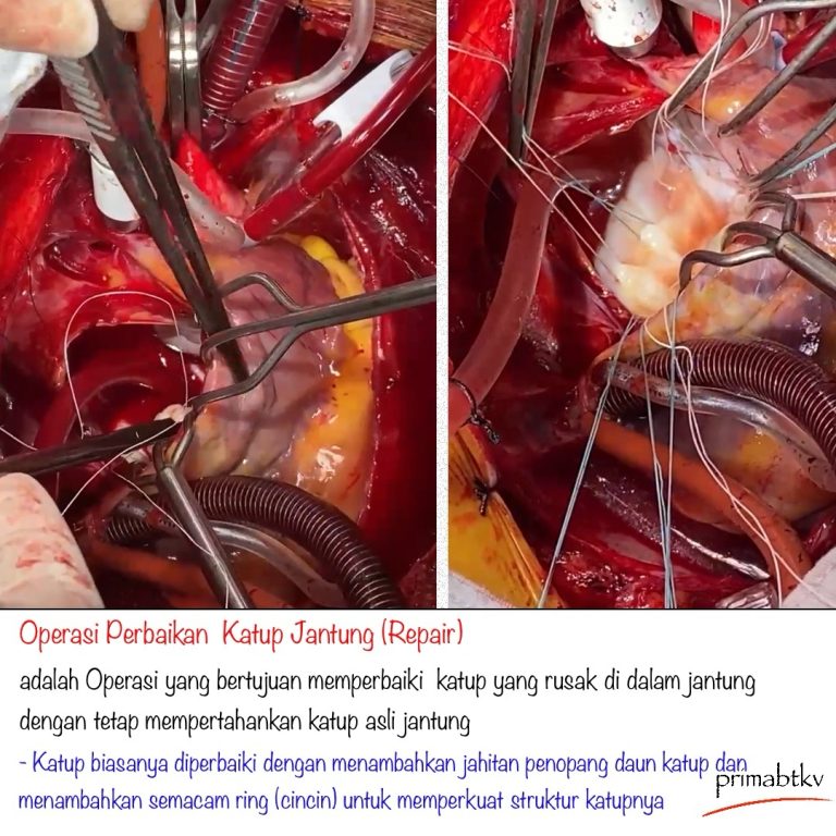 Operasi Perbaikan Katup Jantung (Heart Valve Repair)